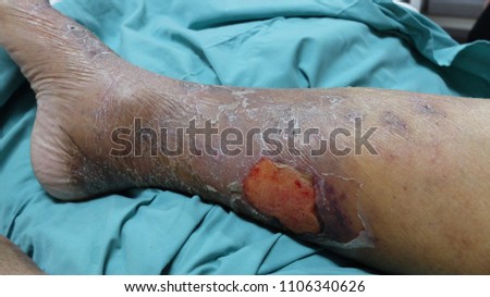 Leg ulcer secondary to cellulitis preceeded by blister formation. Patient also has underlying Chronic Venous Insufficiency.