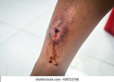 Leg ulcers, gangrene caused by mosquito bites.