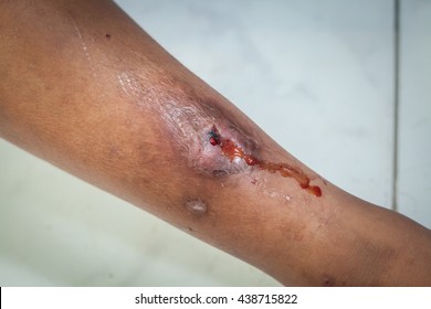 Leg Ulcers, Gangrene Caused By Mosquito Bites.