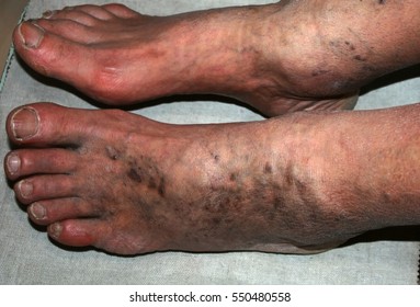 Leg. Varicose Veins. Phlebeurysm. Thrombophlebitis