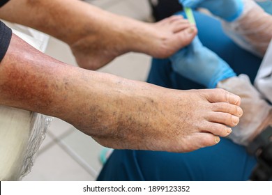 Leg vein disease, dark spots on the skin of the legs, treatment, examination of toenails, fungus. Phlebologist. Complex, care.