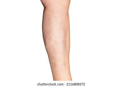 Leg Of A Woman With Grade C3-C4 Chronic Venous Insufficiency. Varicose Syndrome. Leg Photography Isolated On White Background