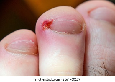 Leg Wound. Close Up Photo Of Human Toenail Infection.