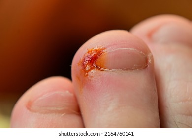 Leg Wound. Close Up Photo Of Human Toenail Infection.