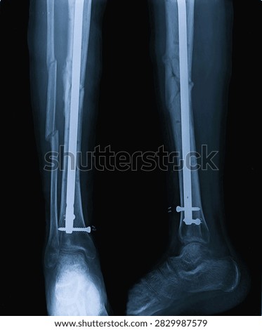 Leg X-ray scan displaying tibia shaft fracture treated with intramedullary interlocking rod