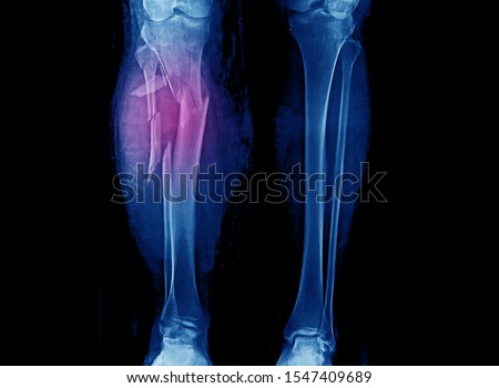 Leg X-ray showing severe open comminuted fracture of proximal tibia and fibula. The patient also has compartment syndrome. The patient needs emergent fasciotomy and external fixation.