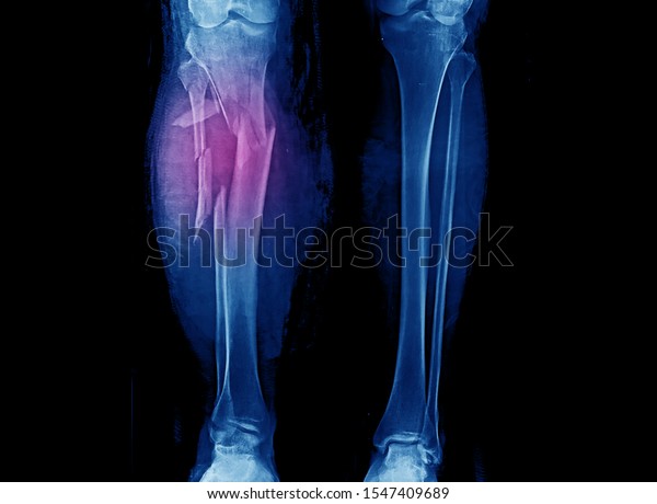 Leg\
X-ray showing severe open comminuted fracture of proximal tibia and\
fibula. The patient also has compartment syndrome. The patient\
needs emergent fasciotomy and external\
fixation.