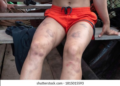   Legs With Bruises. Rock Climbing (deep Water Solo) In Thailand. 