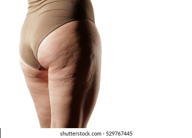 Legs And Buttocks Of Obese Women And Cellulite