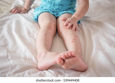 Legs child and mosquito bites sore   scar sitting   scratching bed skin care concept