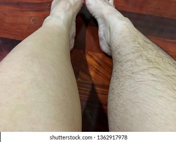 Legs Comparison Of Asian Woman. Left Leg Is Clear Hairless Smooth Skin That Pluck By Flawless Hair Remover Trimmer Body (Electric Women Shaver) Right Leg Is No Shaving Hairy Legs Which Is Hirsutism