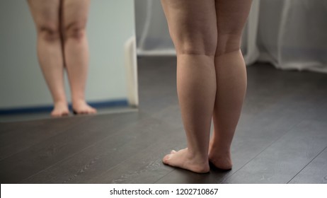 Legs of excess weight woman, flat feet and cellulite issue, obesity problems