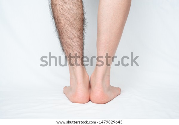 Legs hair removal for men, before & after.\
Applies to one leg only.