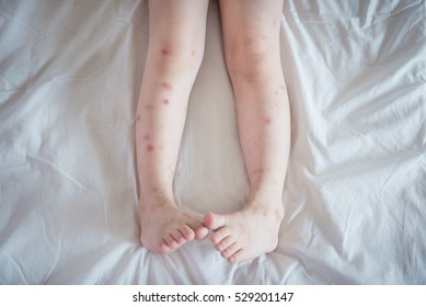 Legs little child and Mosquito bites sore   scar white bed   skin care concept 