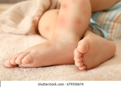 Legs Of Little Child With Red Rash, Closeup. Concept Of Babies Allergies