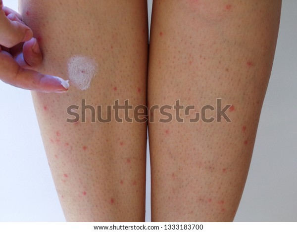 Legs with many red spot and scar from\
mosquitos bites (insect). Mosquitos\
allergy.