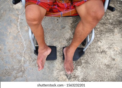 The Legs Of Polio Sufferers Are Smaller Than The Other. The Legs Are Small, No Power, No Strength, Sitting On A Wheelchair. Taken From Above