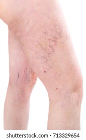 Legs With Spider Varicose Veins Mole