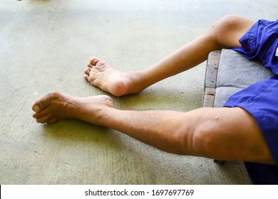 The Legs Are Unequally Small On Both Sides, Not Strong, Caused By Polio. Have To Sit On A Sliding Board On The Cement Floor