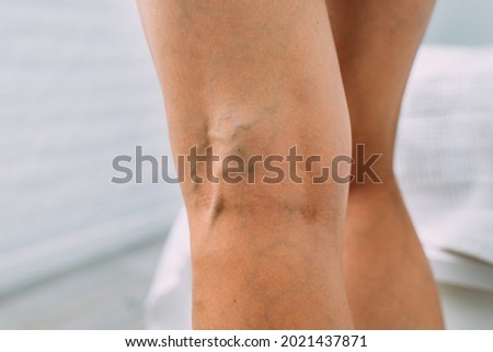 Legs with woman with varicose veins and pronounced mesh.