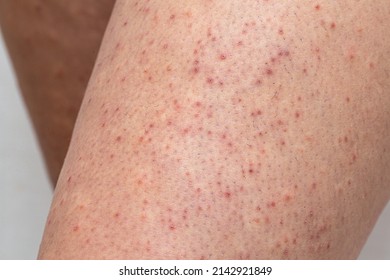 Legskin macro of a young woman suffering from pillar keratosis, frequent cause of atopic dermatitis and sketchy