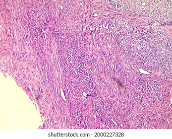 Leiomyoma, Or Fibroids, Is A Smooth Muscle Benign Tumors, Light Micrograph, Photo Under Microscope