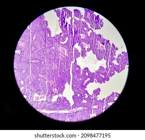 Leiomyoma, Or Fibroids, Is A Smooth Muscle Benign Tumors, Light Micrograph, Photo Under Microscope