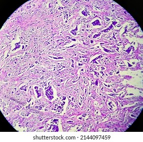 Leiomyoma, Or Fibroids, Is A Smooth Muscle Benign Tumors, Light Micrograph, Photo Under Microscope

