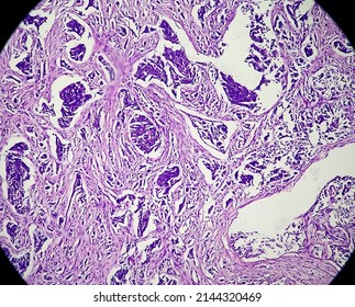 Leiomyoma, Or Fibroids, Is A Smooth Muscle Benign Tumors, Light Micrograph, Photo Under Microscope

