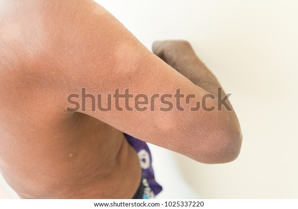 ハンセン病 ハンセン病患者の皮膚 背中の白いバンド 1ヶ月の治療後のハンセン病患者の皮膚 の写真素材 今すぐ編集