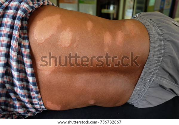 Leprosy, skin of the patient Leprosy , The white band\
on the back of the man