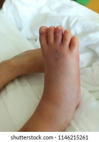 A Lesion Could Be From Snake Centipede Or Scorpion Bite On Dorsal Part Of Right Foot Showed Two Fang Like Marks With Bluish Redness Color Around It, Swollen Foot And Toes. Painful To Touch Or Move