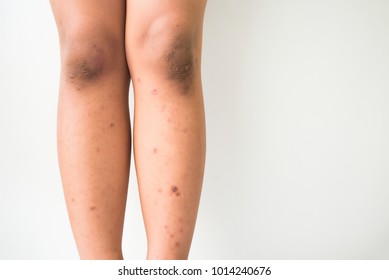 Dark Spots On Legs High Res Stock Images Shutterstock