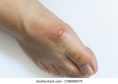 Foot Scab Images, Stock Photos & Vectors | Shutterstock