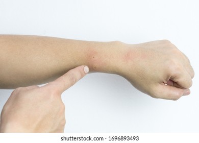 Läsionen von Insektenstichen auf dem Arm.