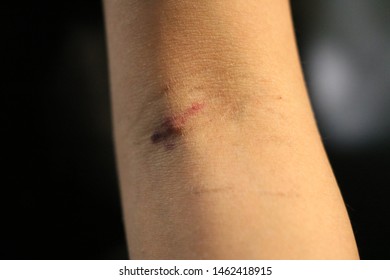 Lethbridge, Alberta/ Canada - July 26 2019: Black And Red Bruised Blood Inner Elbow From Blood Test Needle Injection