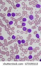 Leukemia (Acute Lymphoblastic Leukemia)