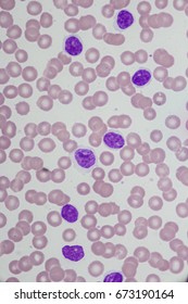 Leukemia (Acute Lymphoblastic Leukemia)