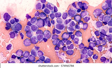 Leukemia Awareness: Photomicrograph Of Bone Marrow Aspirate From A Patient With Leukocytosis, Showing Blast Cells Of Acute Myeloid Leukemia (AML), Type M5, Myelomonocytic, Cancer Of White Blood Cells.