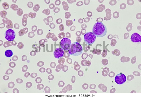 Leukemia Cell Blast Cell 库存照片 立即编辑