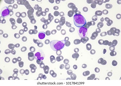 Blast Cells Peripheral Blood Stock Photo (Edit Now) 1853235742