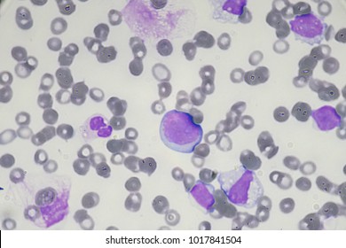 Leukemia Cell (Blast Cell)
Acute Leukemia (Myeloblast)
Myeloblastic 
Hematology