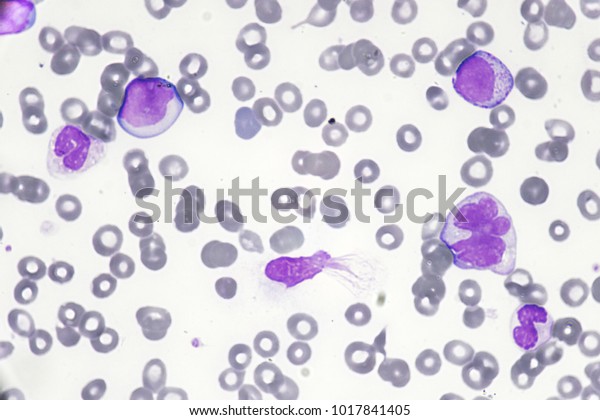 Leukemia Cell Blast Cell Acute Leukemia 库存照片 立即编辑