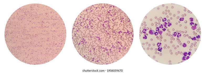 Leukemoid Reaction Describes An Increased White Blood Cell Count, Or Leukocytosis, Which Is A Physiological Response To Stress Or Infection. Canine Peripheral Blood Smear Under Light Microscope.