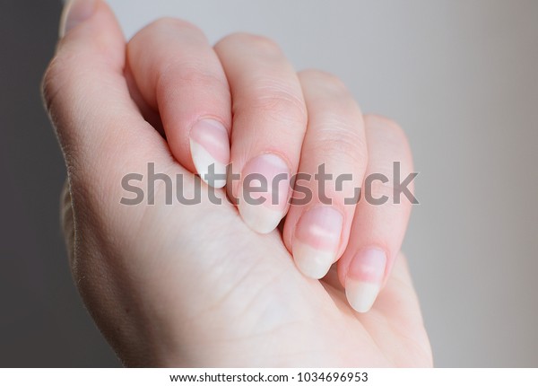 Photo De Stock De Leukonychia Une Femme Met Des Ongles