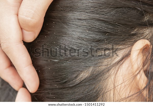 Lice in hair and\
comb on white background