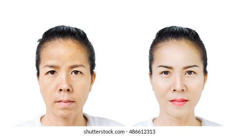 Lift, Eyelid Surgery