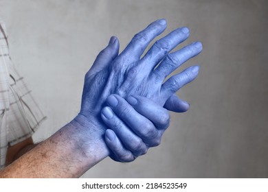 Light Blue Colored Hands Of Asian Old Man. Concept Of Cold And Clumsy Hand.