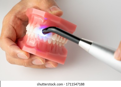 light curing filling on front teeth