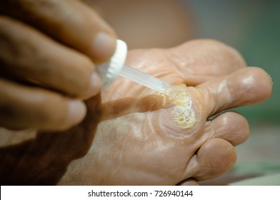 light from LED lighting focus about treatment wart on foot by salicylic acid.